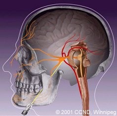 In percutaneous needle procedures, a needle is passed through the cheek up to the gasserion ganglion. 
