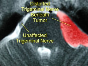 In these MRI images, a tumor that is causing TN is highlighted in red.