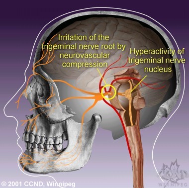 This central (brain stem) hyperactivity is thought to be the underlying source of trigeminal neuralgia pain.