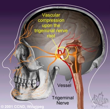 In most typical trigeminal neuralgia sufferers, vessels compress the trigeminal nerve root.