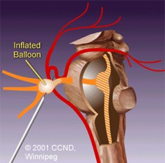 An inflated balloon in Balloon Compression Rhizotomy.