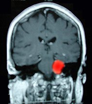 In these MRI images, a tumor that is causing TN is highlighted in red.