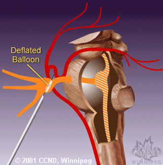 The needle is first positioned to cause injury when inflated.