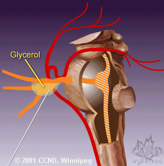 The chemical glycerol is then injected into the space surrounding the trigeminal nerve ganglion.
