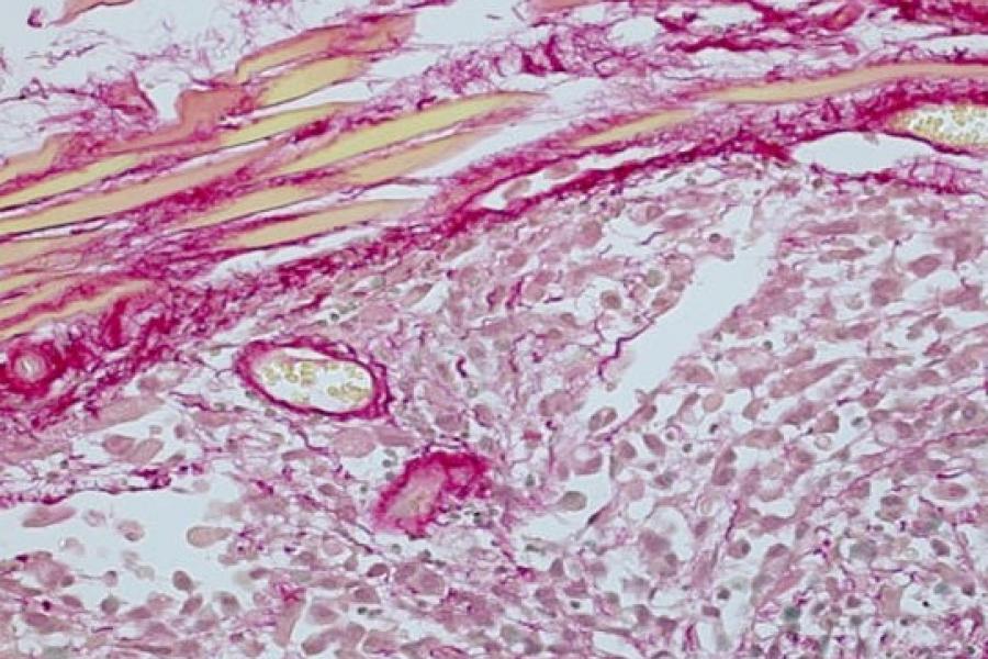 Close up of a slide with cells stained bright pink and other vibrant colours.