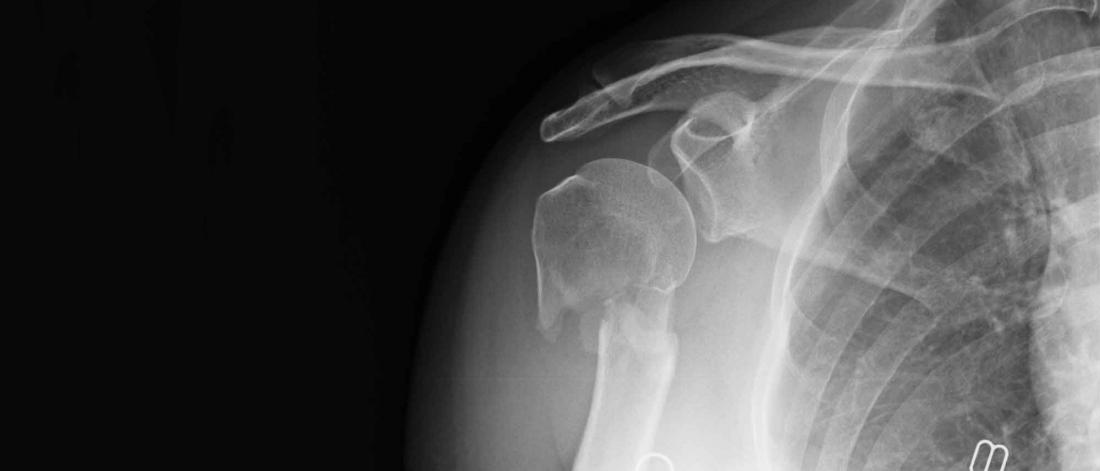 Xray of broken shoulder.