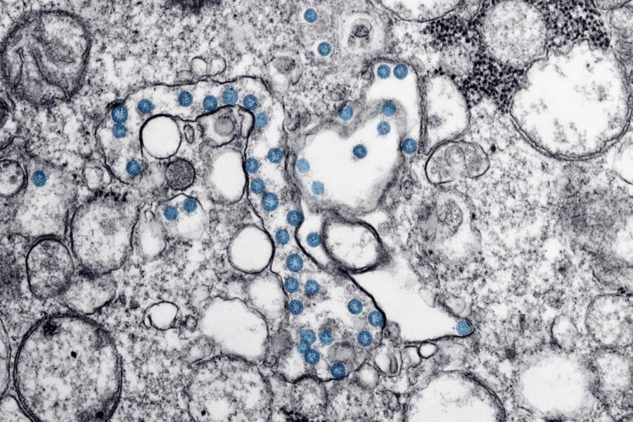TRANSMISSION ELECTRON MICROSCOPIC IMAGE OF AN ISOLATE FROM THE FIRST U.S. CASE OF COVID-19, FORMERLY KNOWN AS 2019-NCOV. THE SPHERICAL VIRAL PARTICLES, COLORIZED BLUE, CONTAIN CROSS-SECTIONS THROUGH THE VIRAL GENOME, SEEN AS BLACK DOTS. CREDIT: CENTERS FOR DISEASE CONTROL.